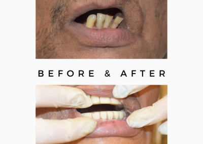 Limited Mouth Opening Surgery