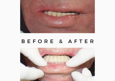 Teeth for Skin Cancer Patient