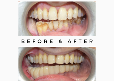 Cancer Rehabilitation Teeth