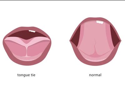 Tonuge Tie Treatment
