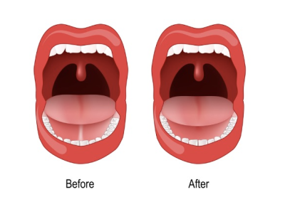 Tonuge Tie Treatment Surgery