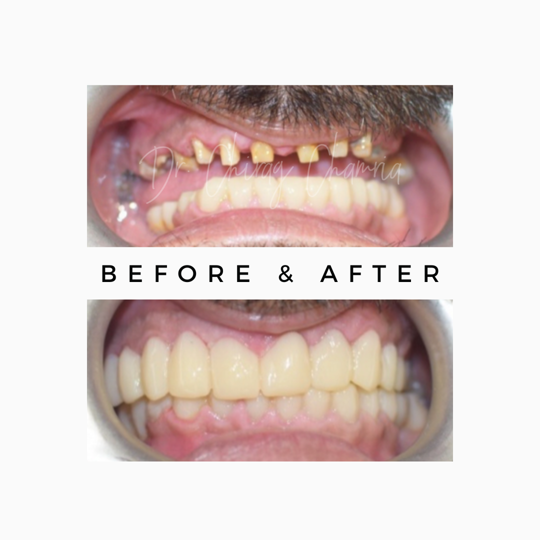Smile Makeover with teeth